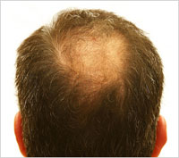 Baldness Hair Loss